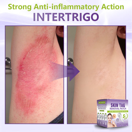 Body skin tag result
